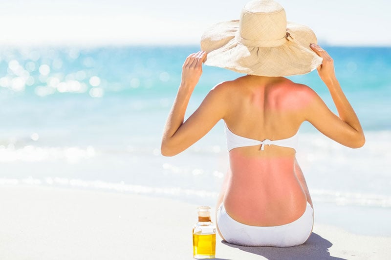The Best Essential Oils for Sunburn and How to Use Them