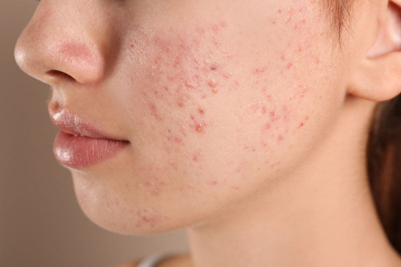 5 Natural Remedies for Cystic Acne