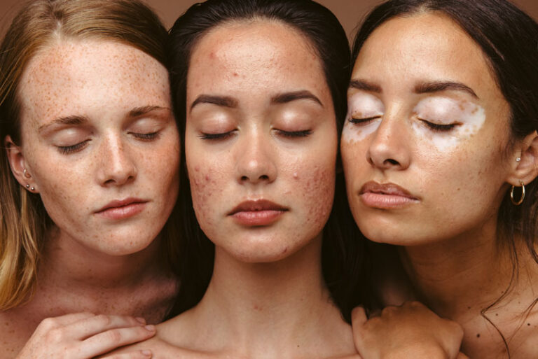 5 Causes of Hormonal Acne & How to Heal