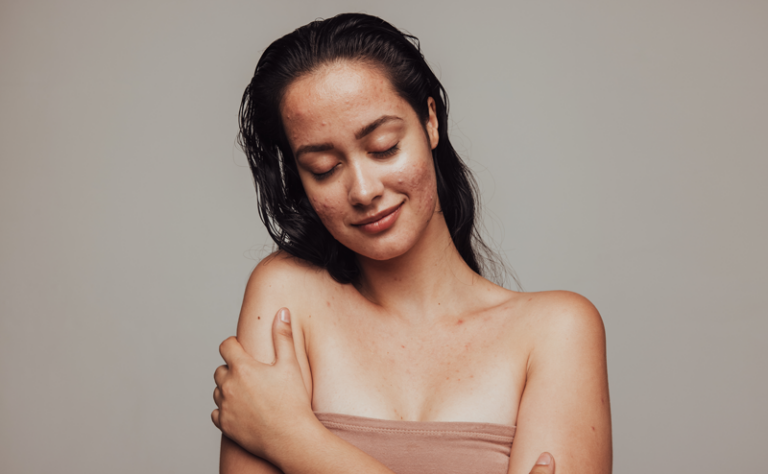 The hormonal Acne Diet for Healing Your Skin